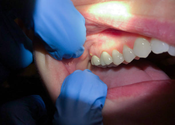 Best Emergency Denture Repair in Gower, MO